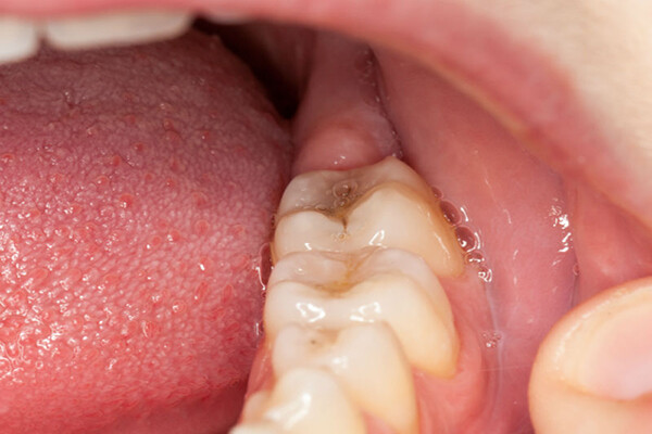 nhổ răng khôn có ảnh hưởng đến sức khỏe không