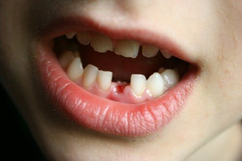 Nhổ răng sữa trẻ em an toàn và không đau