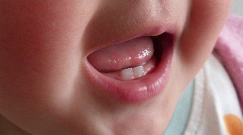 Những bệnh răng miệng trẻ dễ mắc nhất