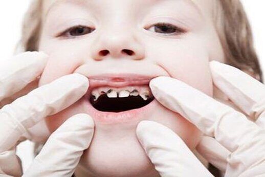 Những bệnh răng miệng trẻ dễ mắc phải