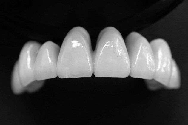 Những biến chứng bọc răng sứ Cercon cần lường trước?