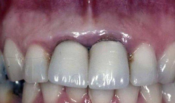 Những biến chứng bọc răng sứ Cercon HT cần lường trước ?