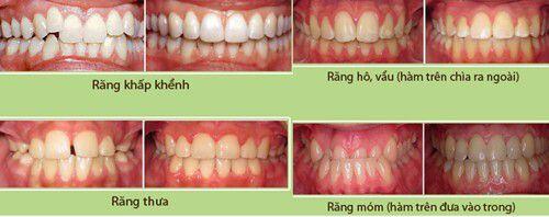 Nguyên nhân gây vẩu răng và cách điều trị
