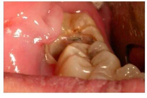 Những dấu hiệu răng miệng cần điều trị tủy răng 1