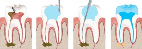 Những dấu hiệu răng miệng cần điều trị tủy răng
