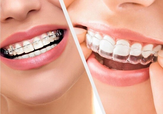 Những điều cần biết về chỉnh hình răng miệng 1
