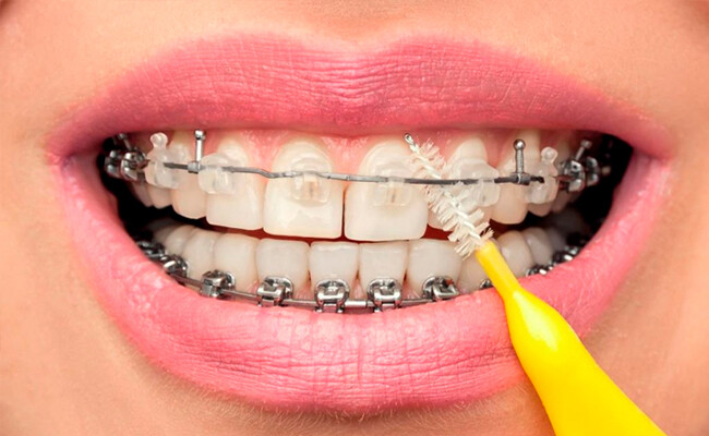 Những điều cần lưu ý trong quá trình niềng răng