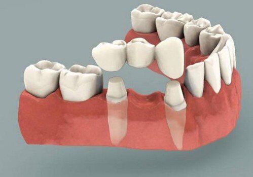 Giải pháp cầu răng cho trường hợp mất răng