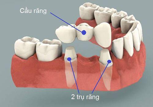 Làm cầu răng hay trồng răng Implant mất nhiều thời gian hơn ?