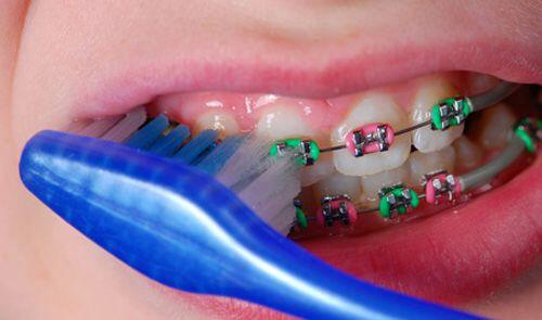 Những lưu ý đề phòng cho trẻ khi đang niềng răng