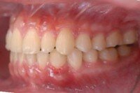 Tác hại của răng lệch khớp cắn