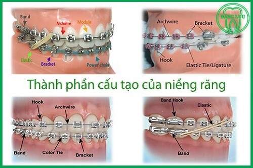Niềng răng bao gồm những thành phần gì ? 1