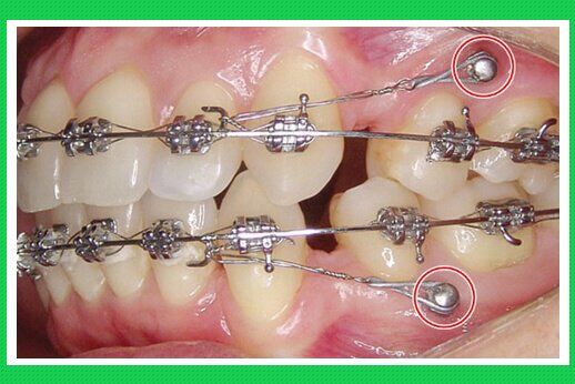 Niềng răng với Minivis và quy trình thực hiện tiêu chuẩn-1