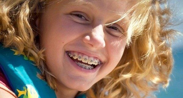 Niềng răng cho trẻ em giá bao nhiêu tiền?