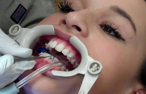 Niềng răng có làm răng yếu đi không ?