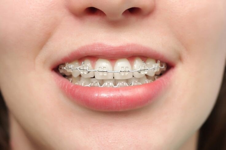 Niềng răng hô hàm trên -3