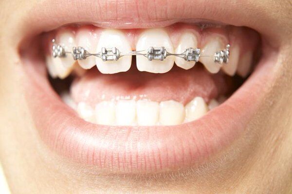niềng răng hô hàm trên có được không?