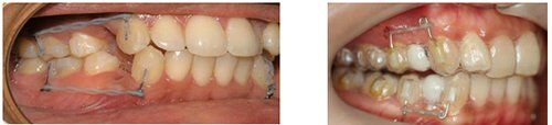 niềng răng invisalign G6