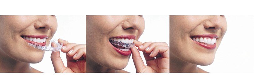 niềng răng invisalign trong suốt