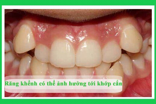 nieng-rang-khenh-3