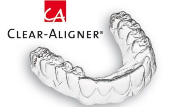 Niềng răng không mắc cài Clear Aligner