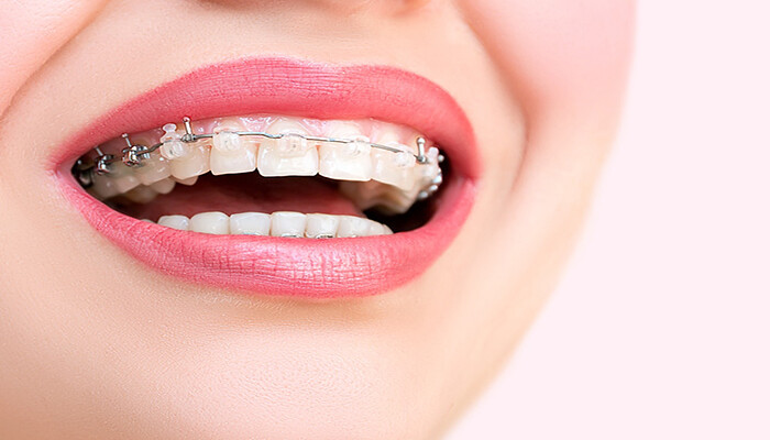Niềng răng mắc cài sứ tự buộc có ưu điểm gì so với mắc cài thường