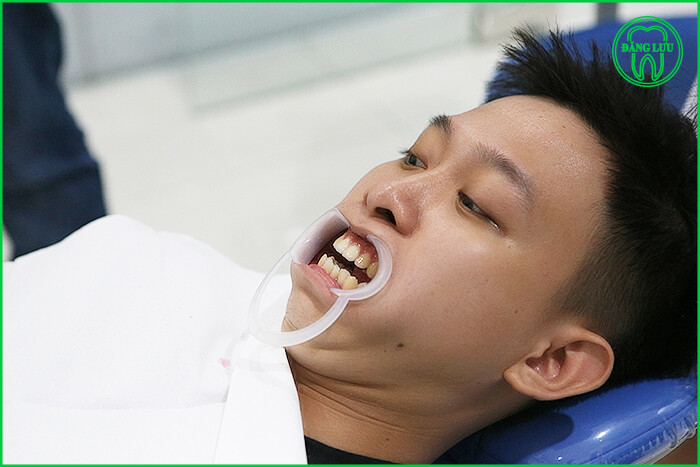 Niềng răng mặt lưỡi tại TP.HCM
