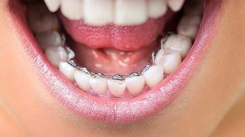 Thời gian niềng răng mất bao lâu ?