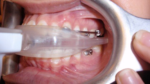 Khí cụ giúp răng mọc đúng vị trí khi răng sữa mất sớm