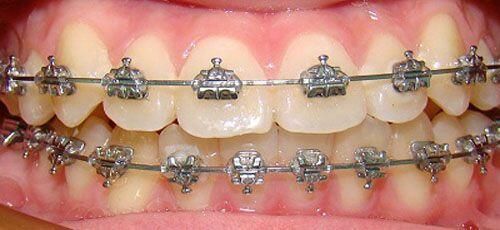 Giải pháp điều trị thưa răng hiệu quả