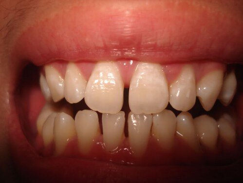 Nguyên nhân khiến răng bị thưa dần