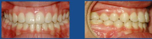 Cách xác định phương pháp điều trị răng hô
