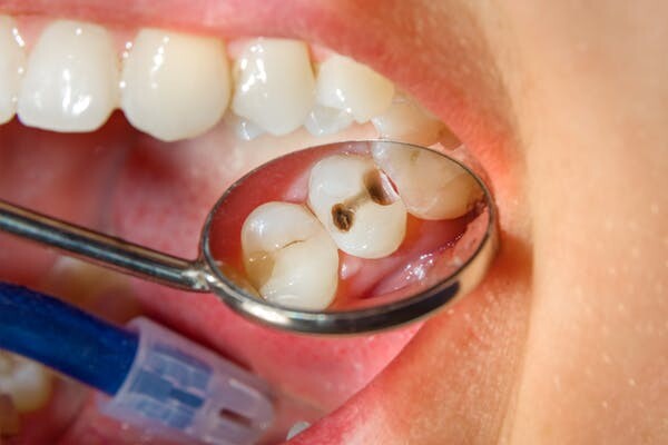 Biện pháp phòng ngừa bệnh sâu răng