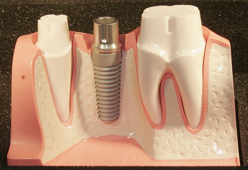 lợi ích của việc cấy ghép răng implant