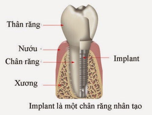 Cấy ghép implant gắn răng liền