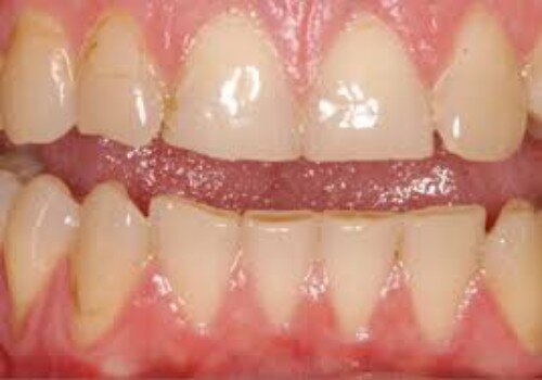 Phương pháp để mặt răng không bị mòn
