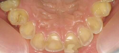 Phương pháp để mặt răng không bị mòn