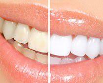 Phương pháp tẩy trắng răng an toàn nào ?