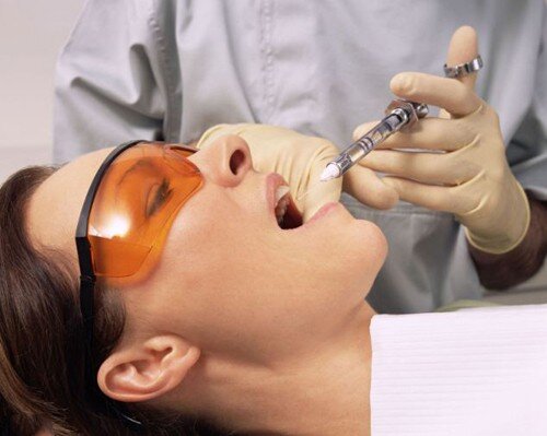 Phương pháp nhổ răng khôn không đau