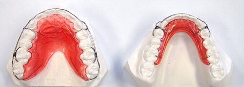 phương pháp niềng răng cho trẻ em ở độ tuổi tăng trưởng