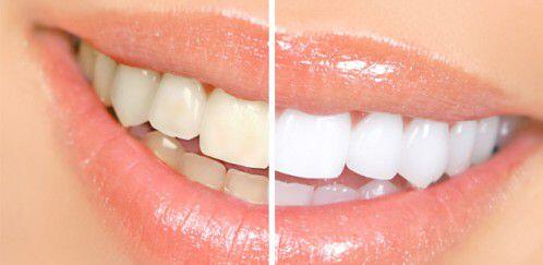 Phương pháp tẩy trắng răng an toàn nào tốt nhất?