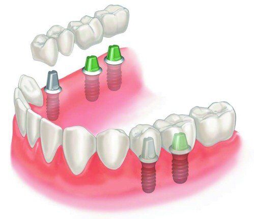 Phương pháp thay thế răng mất mà không làm cầu răng