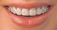 Phương pháp điều trị tình trạng răng mọc chen lấn nhau