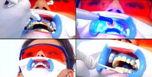 Laser whitening phương pháp tẩy trắng răng siêu hiệu quả