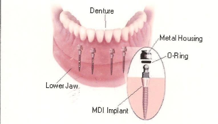 quy trình cấy ghép mini- Implant