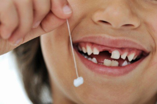 Quy trình nhổ răng trẻ em