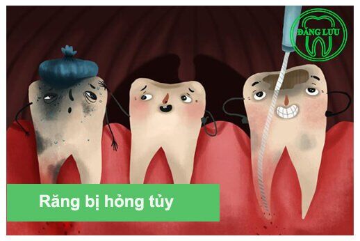 Điều trị tủy khi chân răng bị cong