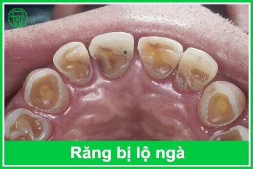Điều trị tình trạng răng bị lộ ngà