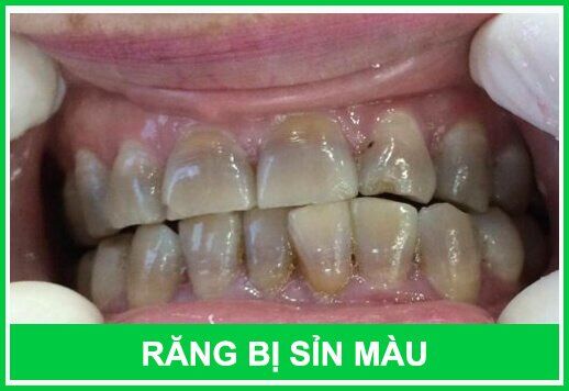 Nguyên nhân khiến răng bị nhiễm màu từ bên trong