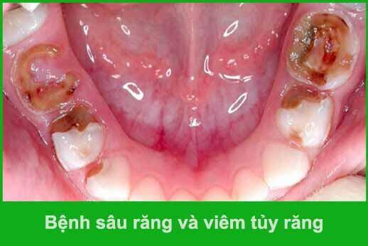 bệnh sâu răng và viêm tủy